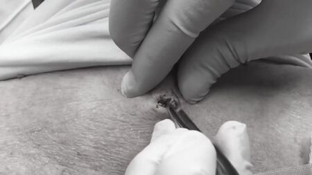 La dottoressa Lee estrae un punto nero ENORME - Dott.ssa Sandra Lee, specialista in dermatologia - Discovery HH_1080p
